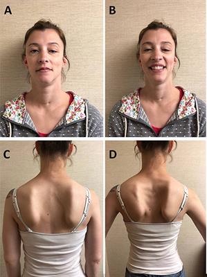 Congenital Vocal Cord Paralysis and Late-Onset Limb-Girdle Weakness in MuSK–Congenital Myasthenic Syndrome